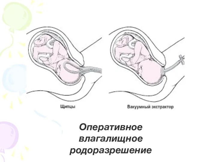 Оперативное влагалищное родоразрешение