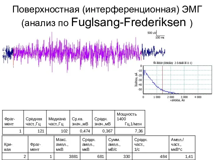 Поверхностная (интерференционная) ЭМГ (анализ по Fuglsang-Frederiksen )