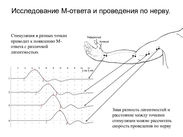 Исследование М-ответа и проведения по нерву. Стимуляция в разных точках