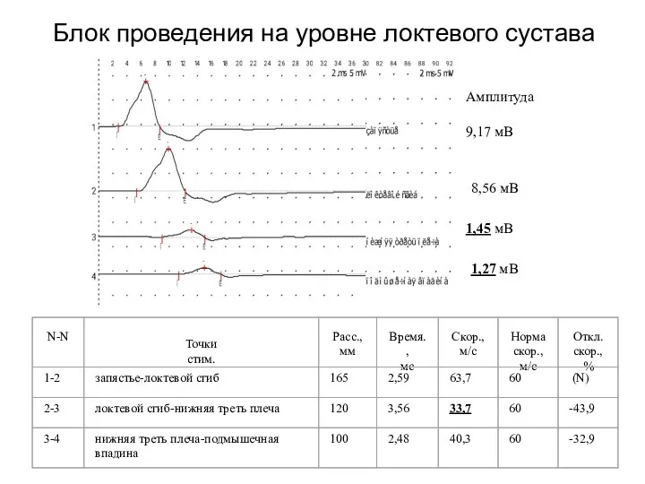 Блок проведения на уровне локтевого сустава Амплитуда 8,56 мВ 1,45 мВ 1,27 мВ 9,17 мВ