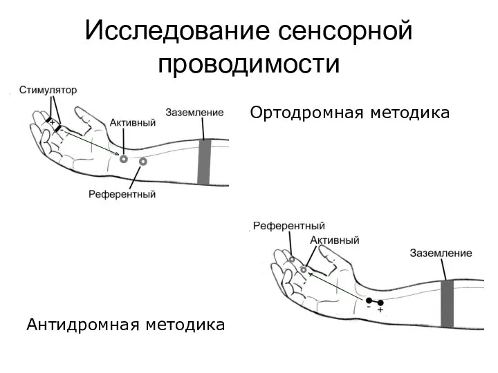 Исследование сенсорной проводимости Ортодромная методика Антидромная методика