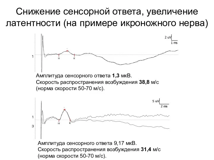 Снижение сенсорной ответа, увеличение латентности (на примере икроножного нерва) Амплитуда