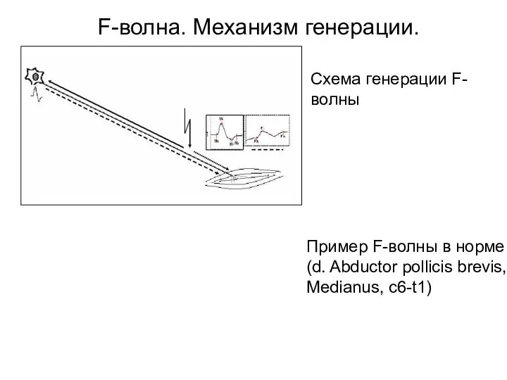 F-волна. Механизм генерации. Схема генерации F-волны Пример F-волны в норме (d. Abductor pollicis brevis, Medianus, c6-t1)