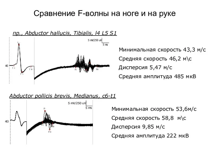 Сравнение F-волны на ноге и на руке Минимальная скорость 43,3