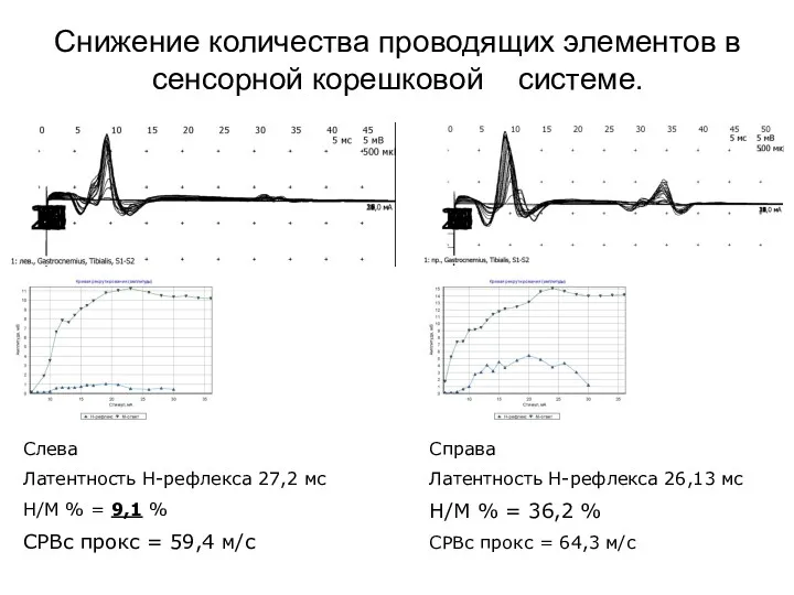 Снижение количества проводящих элементов в сенсорной корешковой системе. Справа Латентность