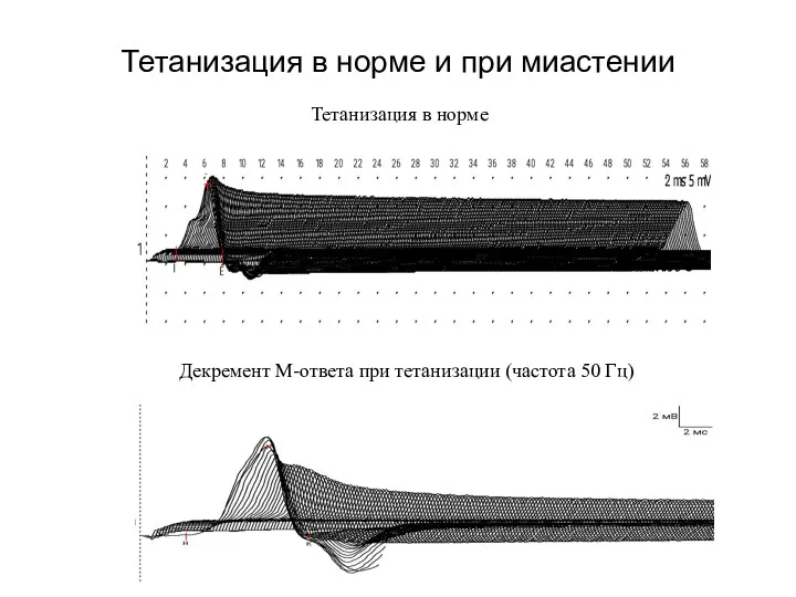 Тетанизация в норме и при миастении