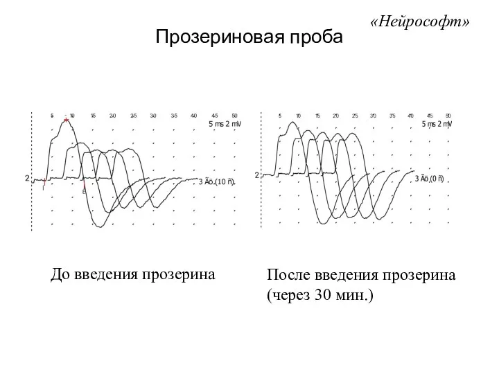 Прозериновая проба «Нейрософт» До введения прозерина После введения прозерина (через 30 мин.)