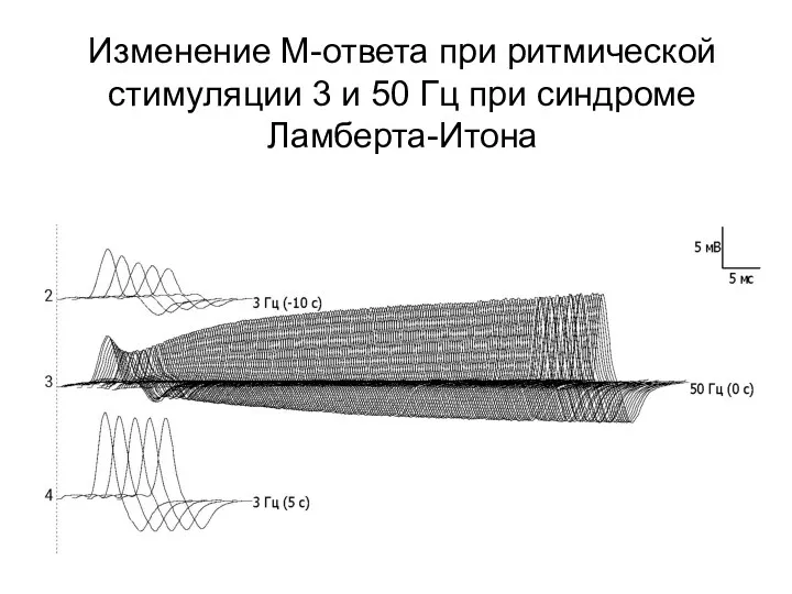 Изменение М-ответа при ритмической стимуляции 3 и 50 Гц при синдроме Ламберта-Итона