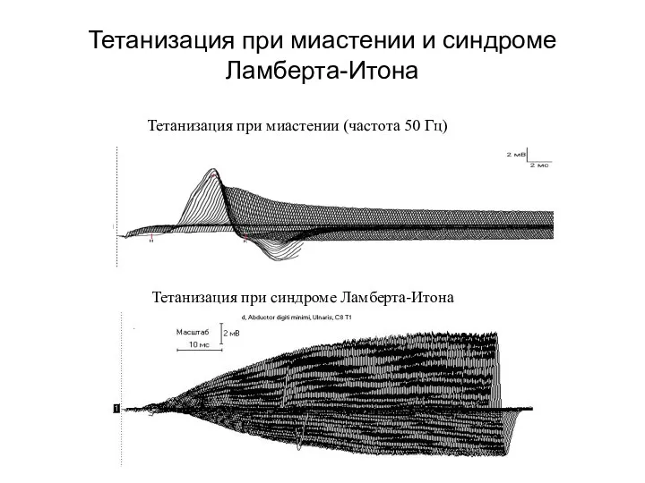 Тетанизация при миастении и синдроме Ламберта-Итона Тетанизация при синдроме Ламберта-Итона