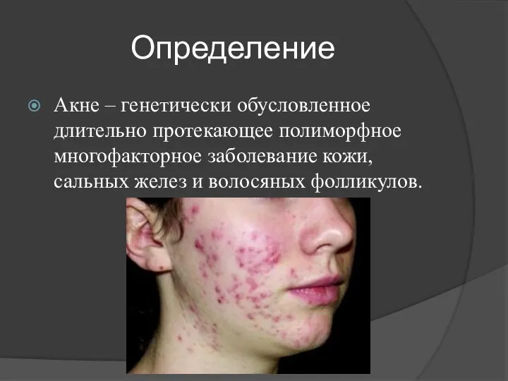 Определение Акне – генетически обусловленное длительно протекающее полиморфное многофакторное заболевание кожи, сальных желез и волосяных фолликулов.