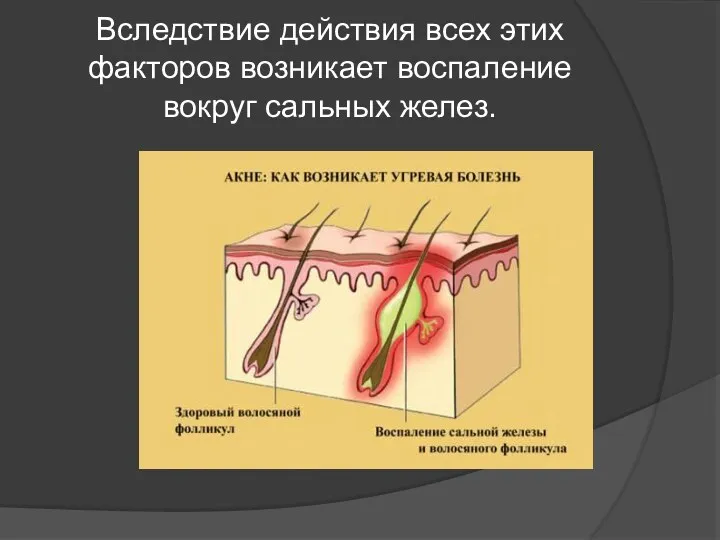 Вследствие действия всех этих факторов возникает воспаление вокруг сальных желез.