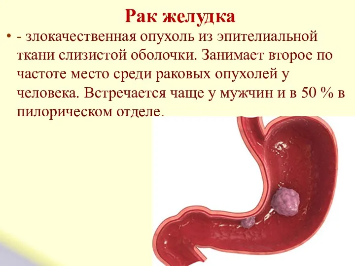 Рак желудка - злокачественная опухоль из эпителиальной ткани слизистой оболочки.
