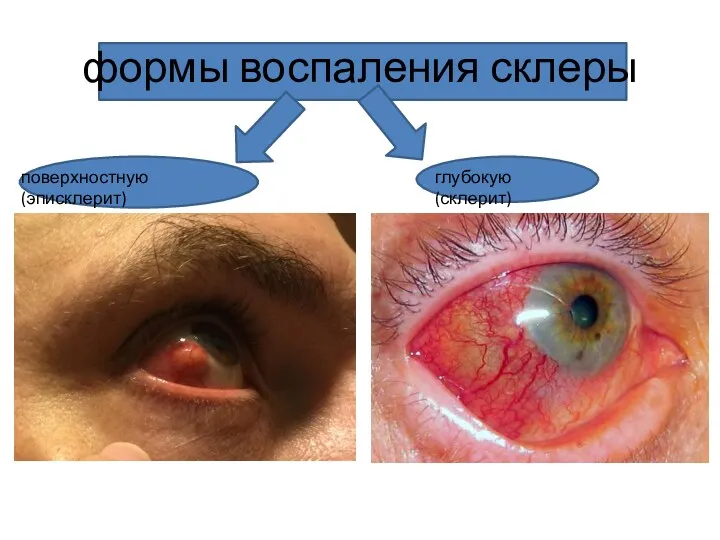 формы воспаления склеры поверхностную (эписклерит) глубокую (склерит)