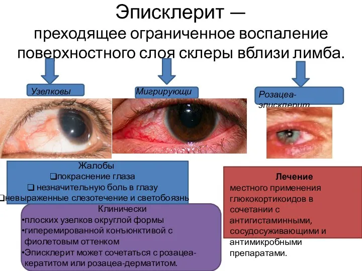 Эписклерит — преходящее ограниченное воспаление поверхностного слоя склеры вблизи лимба.