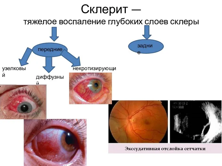 Склерит — тяжелое воспаление глубоких слоев склеры передние задние диффузный узелковый некротизирующий