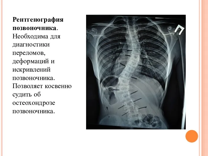 Рентгенография позвоночника. Необходима для диагностики переломов, деформаций и искривлений позвоночника. Позволяет косвенно судить об остеохондрозе позвоночника.