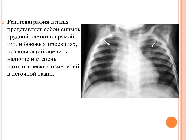 Рентгенография легких представляет собой снимок грудной клетки в прямой и/или боковых проекциях, позволяющий