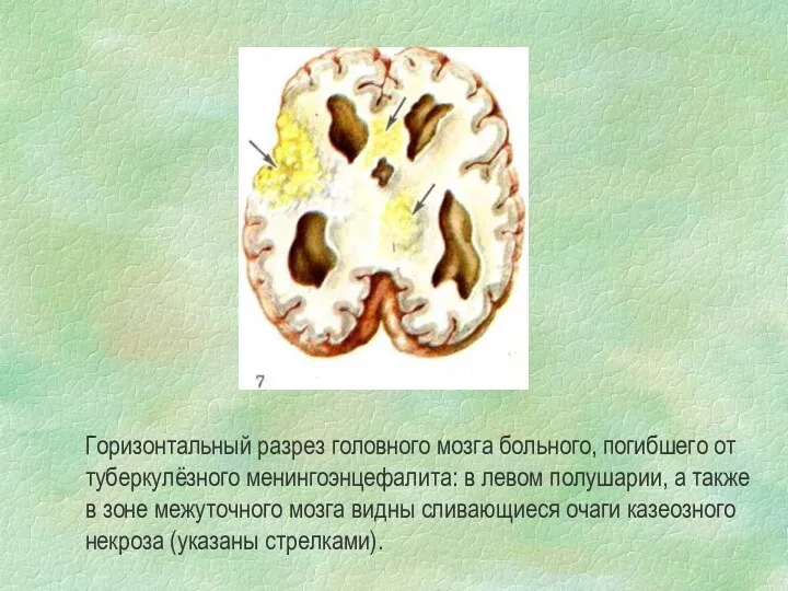 Горизонтальный разрез головного мозга больного, погибшего от туберкулёзного менингоэнцефалита: в