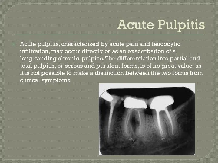 Acute Pulpitis Acute pulpitis, characterized by acute pain and leucocytic