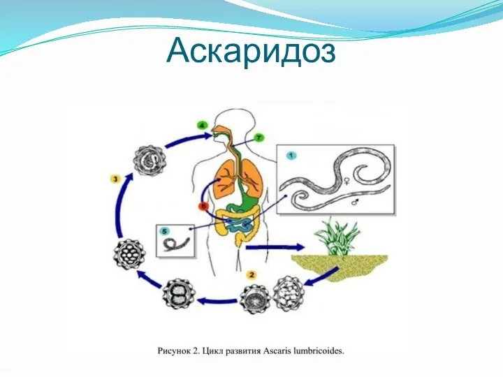 Аскаридоз