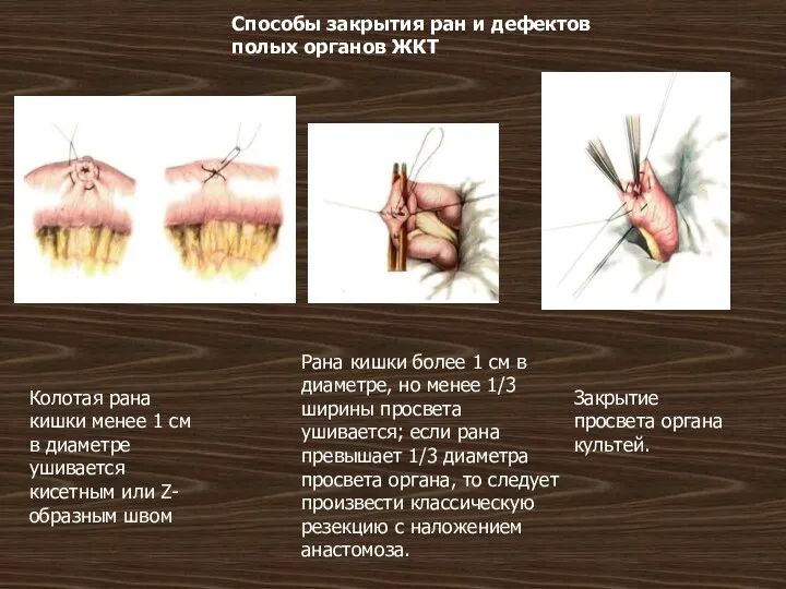 Способы закрытия ран и дефектов полых органов ЖКТ Колотая рана