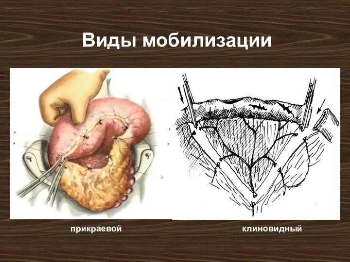 Виды мобилизации прикраевой клиновидный