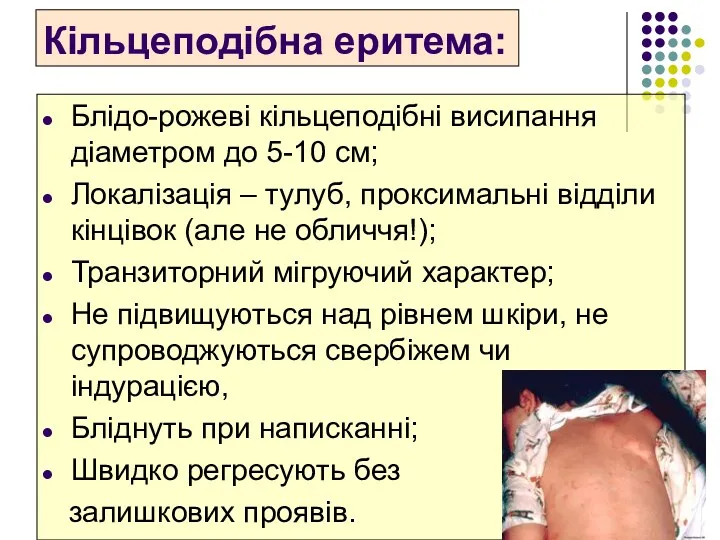 Кільцеподібна еритема: Блідо-рожеві кільцеподібні висипання діаметром до 5-10 см; Локалізація