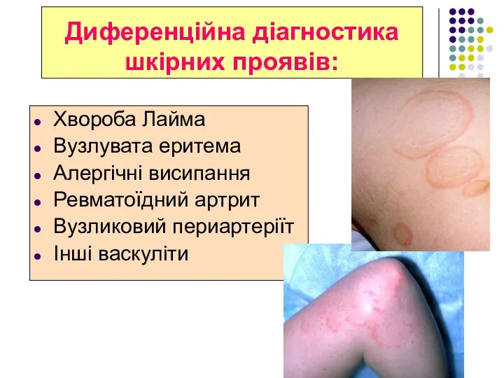 Диференційна діагностика шкірних проявів: Хвороба Лайма Вузлувата еритема Алергічні висипання Ревматоїдний артрит Вузликовий периартеріїт Інші васкуліти
