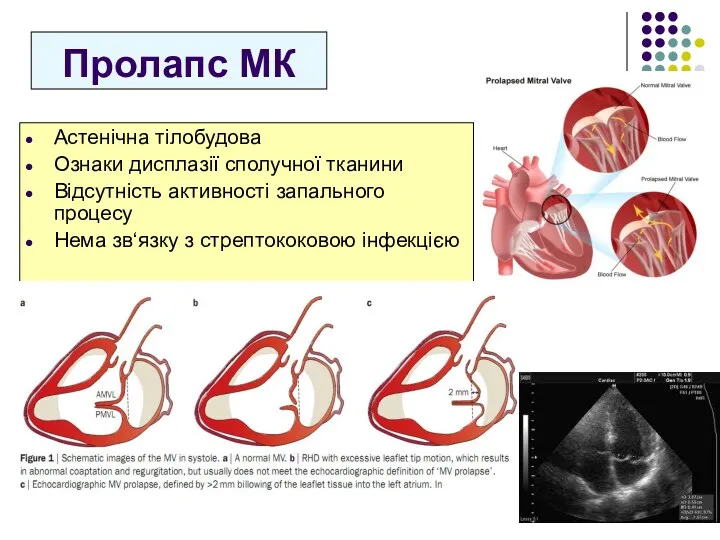 Пролапс МК Астенічна тілобудова Ознаки дисплазії сполучної тканини Відсутність активності