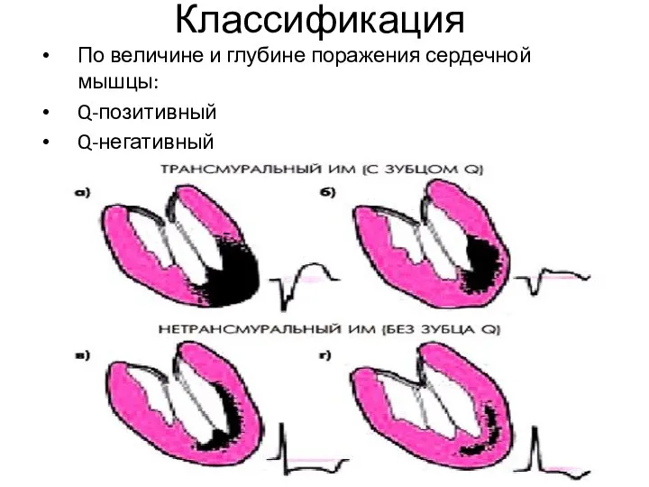 Классификация По величине и глубине поражения сердечной мышцы: Q-позитивный Q-негативный