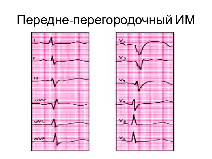 Передне-перегородочный ИМ