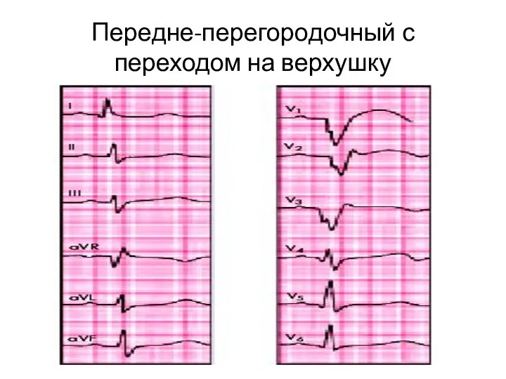 Передне-перегородочный с переходом на верхушку