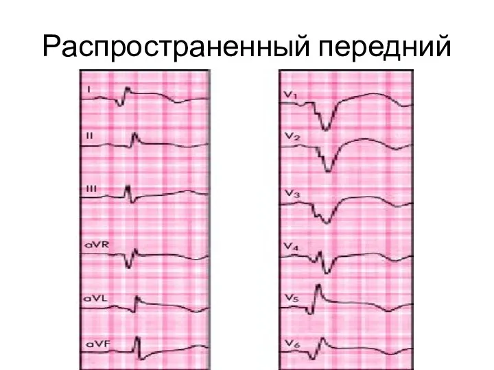 Распространенный передний