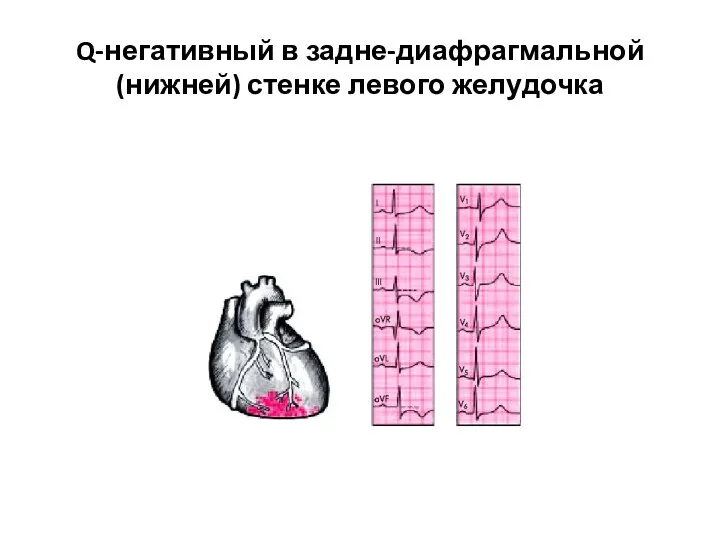 Q-негативный в задне-диафрагмальной(нижней) стенке левого желудочка