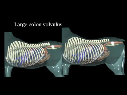 Large colon volvulus