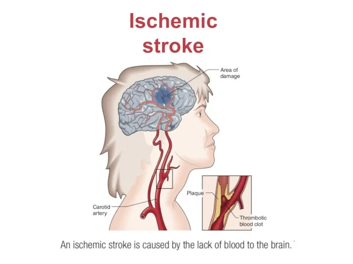 Ischemic stroke