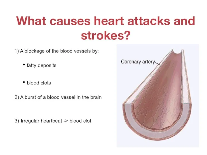 What causes heart attacks and strokes? 1) A blockage of