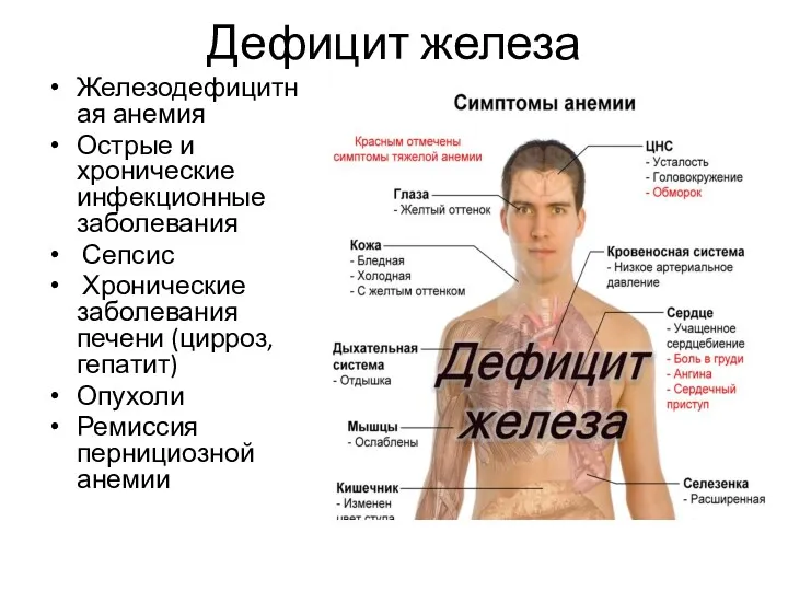 Дефицит железа Железодефицитная анемия Острые и хронические инфекционные заболевания Сепсис Хронические заболевания печени