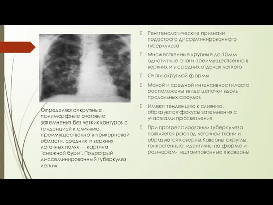 Рентгенологические признаки подострого диссеминированного туберкулеза Множественные крупные до 10мм однотипные