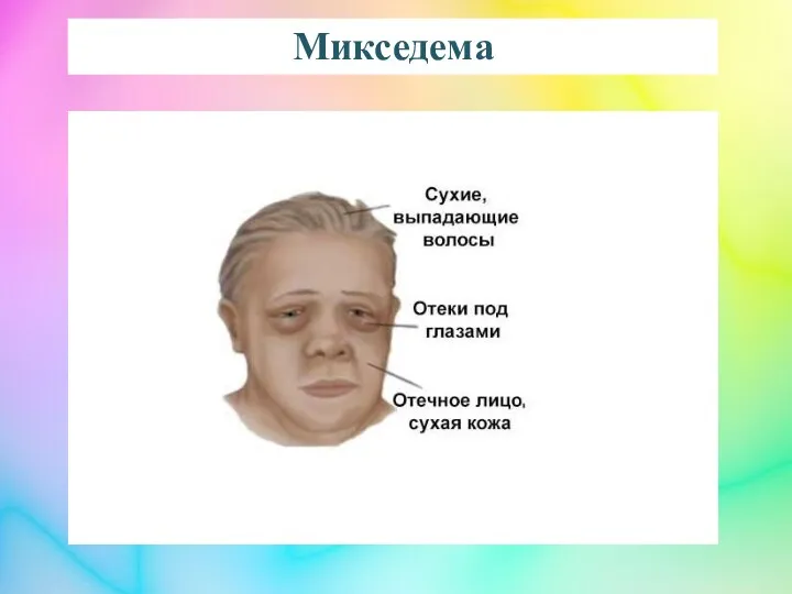 Микседема