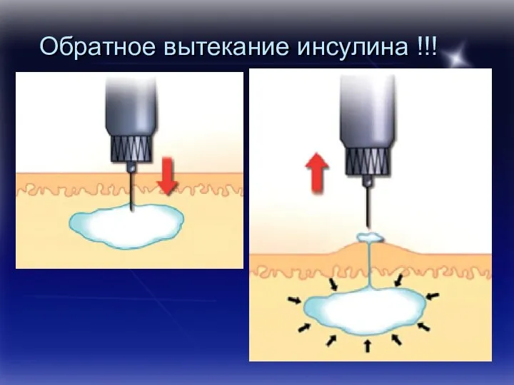 Обратное вытекание инсулина !!!