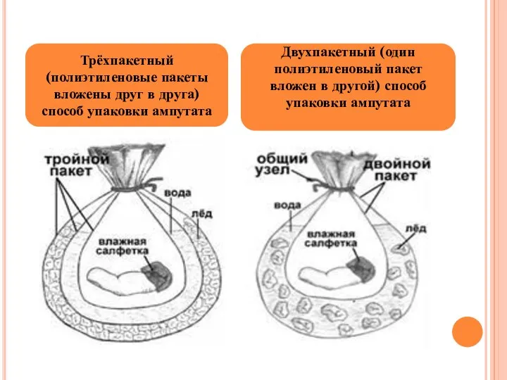 Трёхпакетный (полиэтиленовые пакеты вложены друг в друга) способ упаковки ампутата