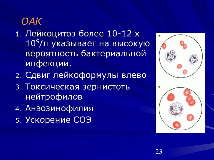 ОАК Лейкоцитоз более 10-12 х 109/л указывает на высокую вероятность бактериальной инфекции. Сдвиг