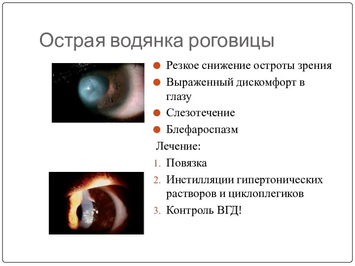 Острая водянка роговицы Резкое снижение остроты зрения Выраженный дискомфорт в