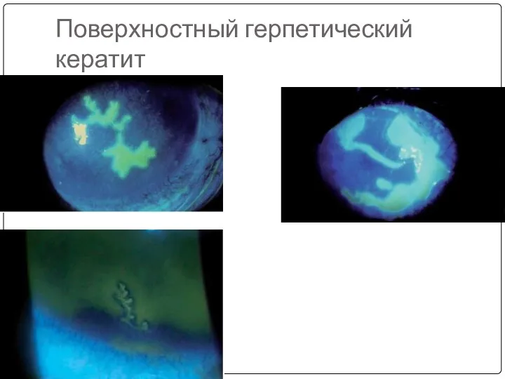 Поверхностный герпетический кератит