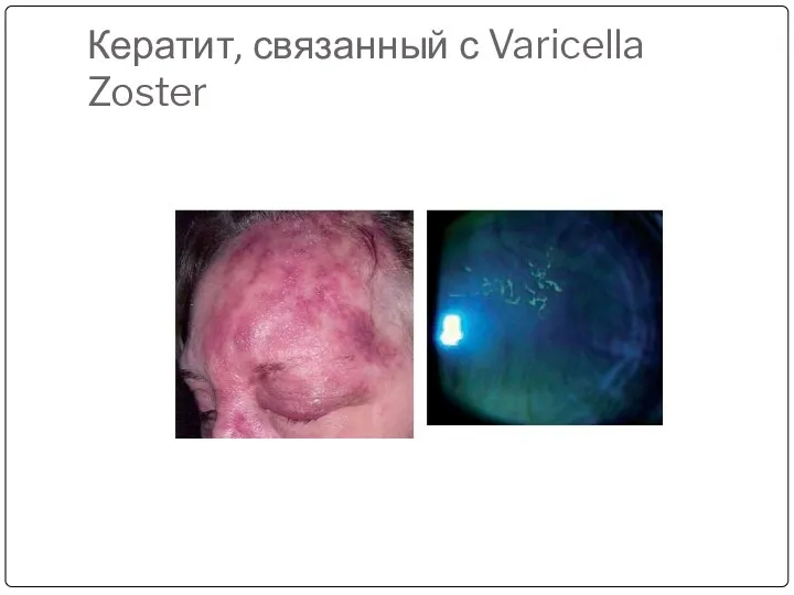 Кератит, связанный с Varicella Zoster