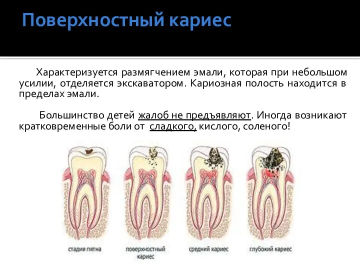 Поверхностный кариес Характеризуется размягчением эмали, которая при небольшом усилии, отделяется