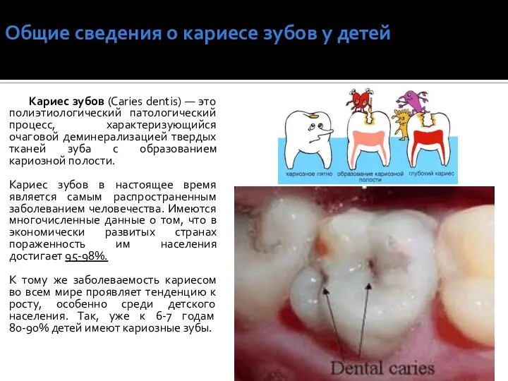 Общие сведения о кариесе зубов у детей Кариес зубов (Caries dentis) — это