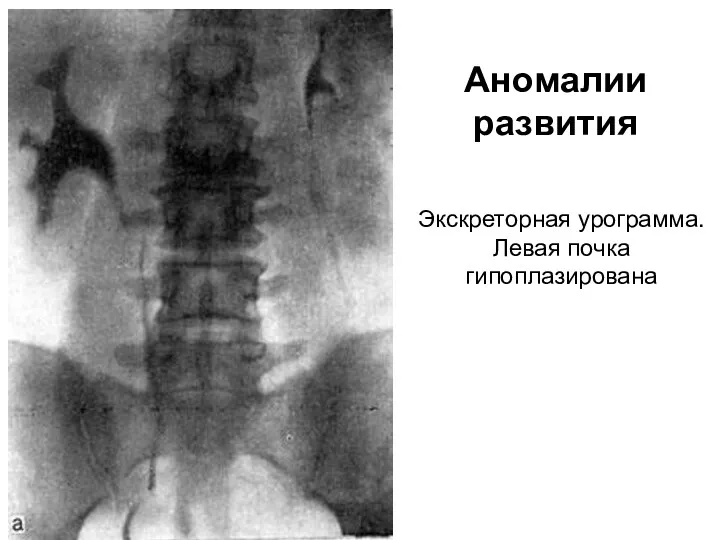 Экскреторная урограмма. Левая почка гипоплазирована Аномалии развития