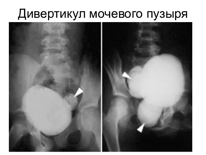 Дивертикул мочевого пузыря